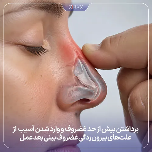 علت بیرون زدگی غضروف بینی بعد از عمل