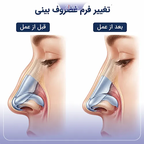 تغییر غضروف بینی بعد از عمل بینی