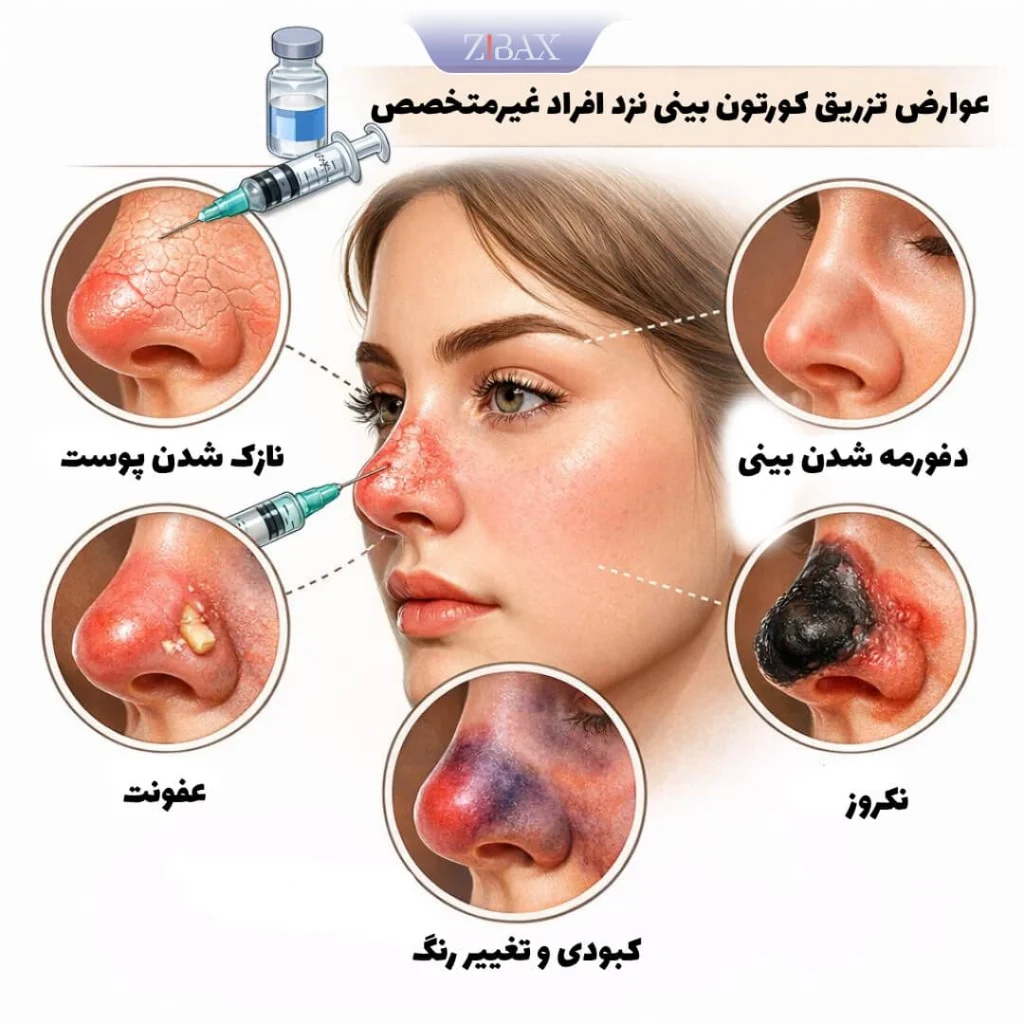 اینفوگرافی نشان دهنده عوارض تزریق کورتون بعد از عمل بینی نزد افراد غیر متخصص؛ از نکروز و عفونت گرفته تا دفرمه شدن بینی