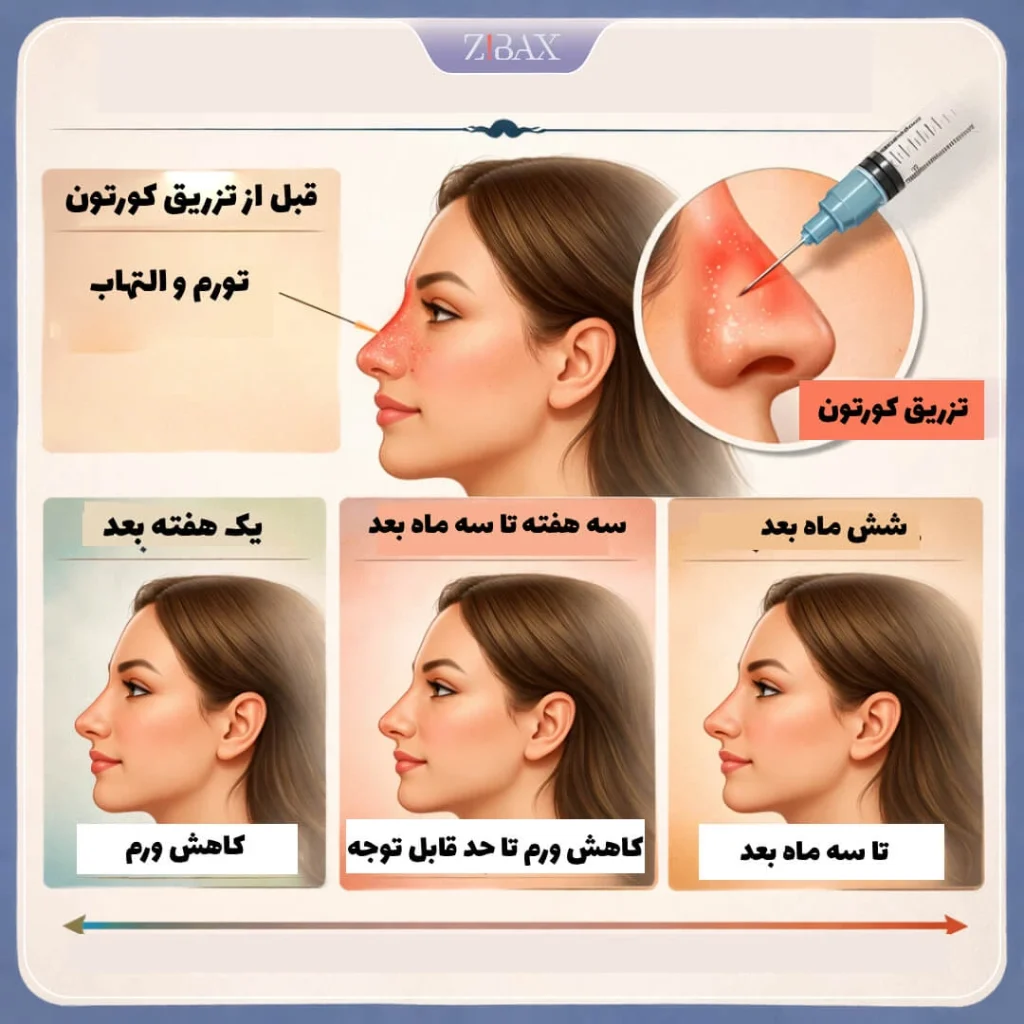 اینفوگرافی میزان ماندگاری کورتون بعد از عمل بینی؛ تا 6 ماه