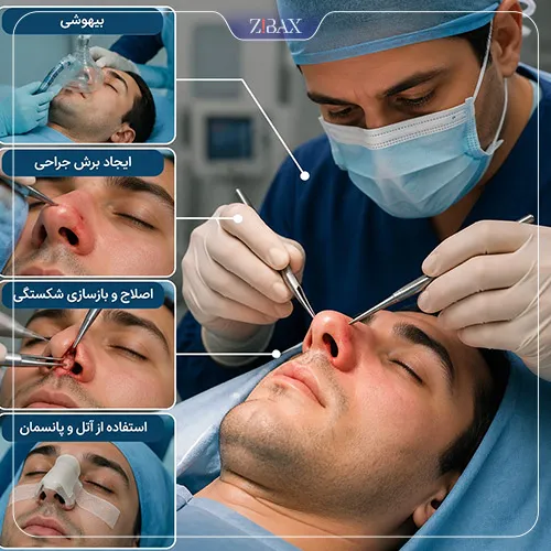 نحوه انجام عمل شکستگی بینی