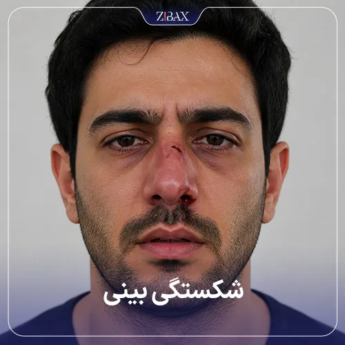 عمل شکستگی بینی