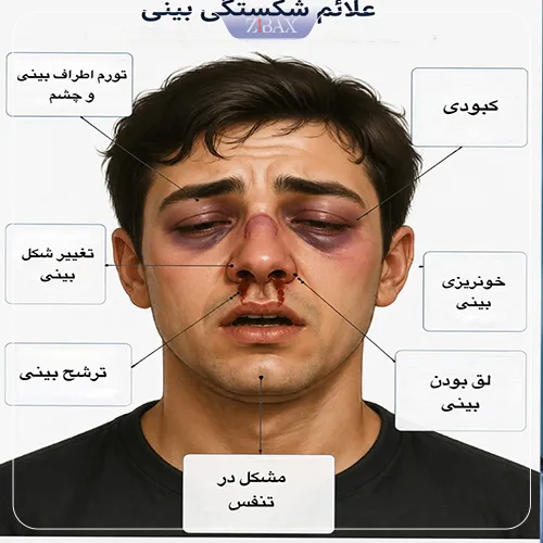 بررسی علائم و نشانههای شکستگی بینی
