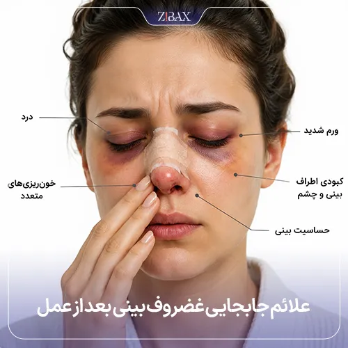 نشانه‌های تغییر غضروف بینی بعد از رینوپلاستی