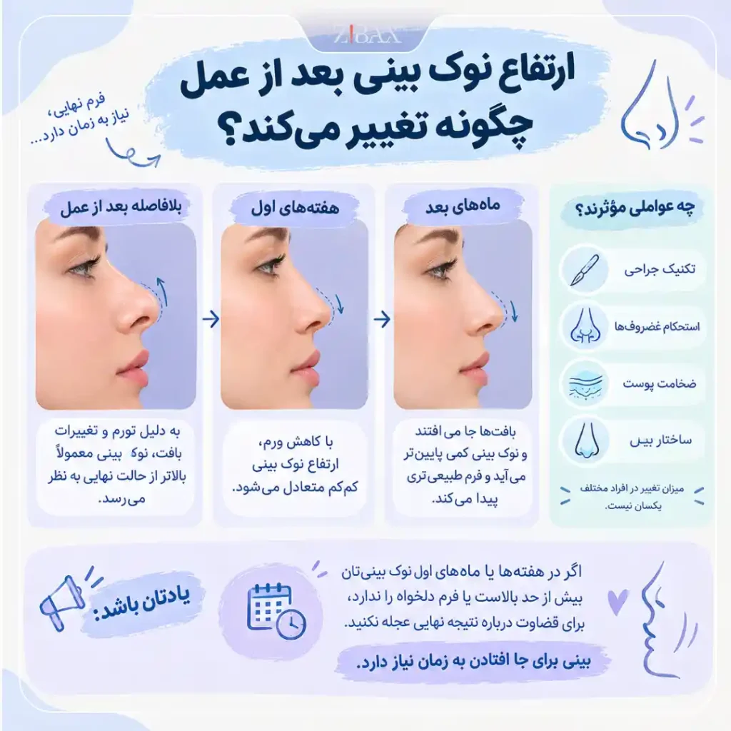 ارتفاع نوک بینی بعد از عمل