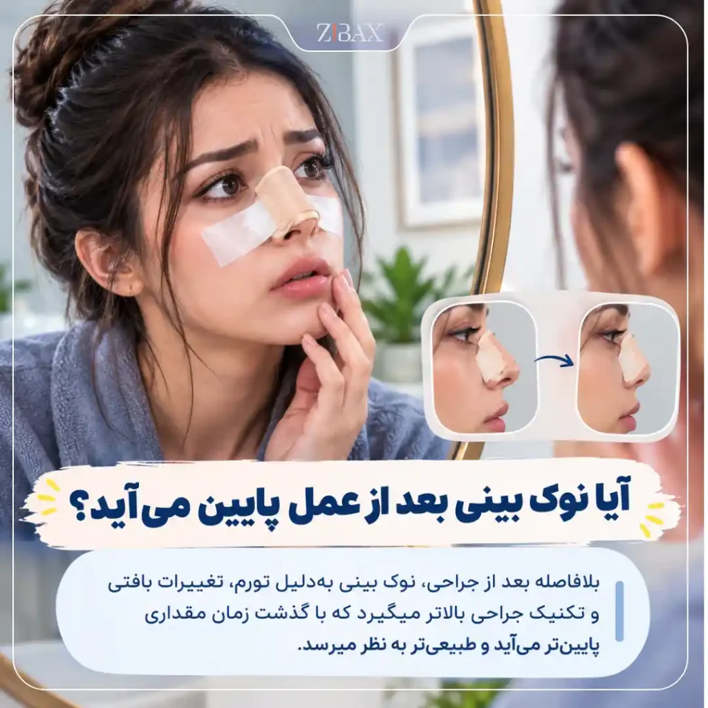 آیا نوک بینی بعد از عمل پایین می آید