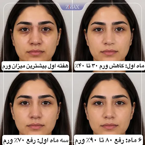 بررسی نحوه و مراحل کاهش ورم بینی پس از عمل