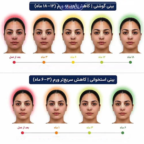 تفاوت ورم بینی در بینی‌های گوشتی و استخوانی