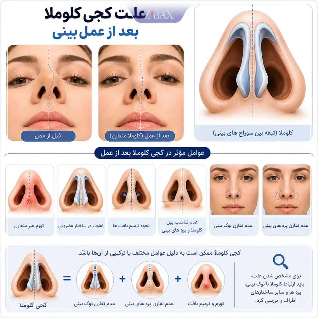 علت کجی کلوملا بعد از عمل بینی
