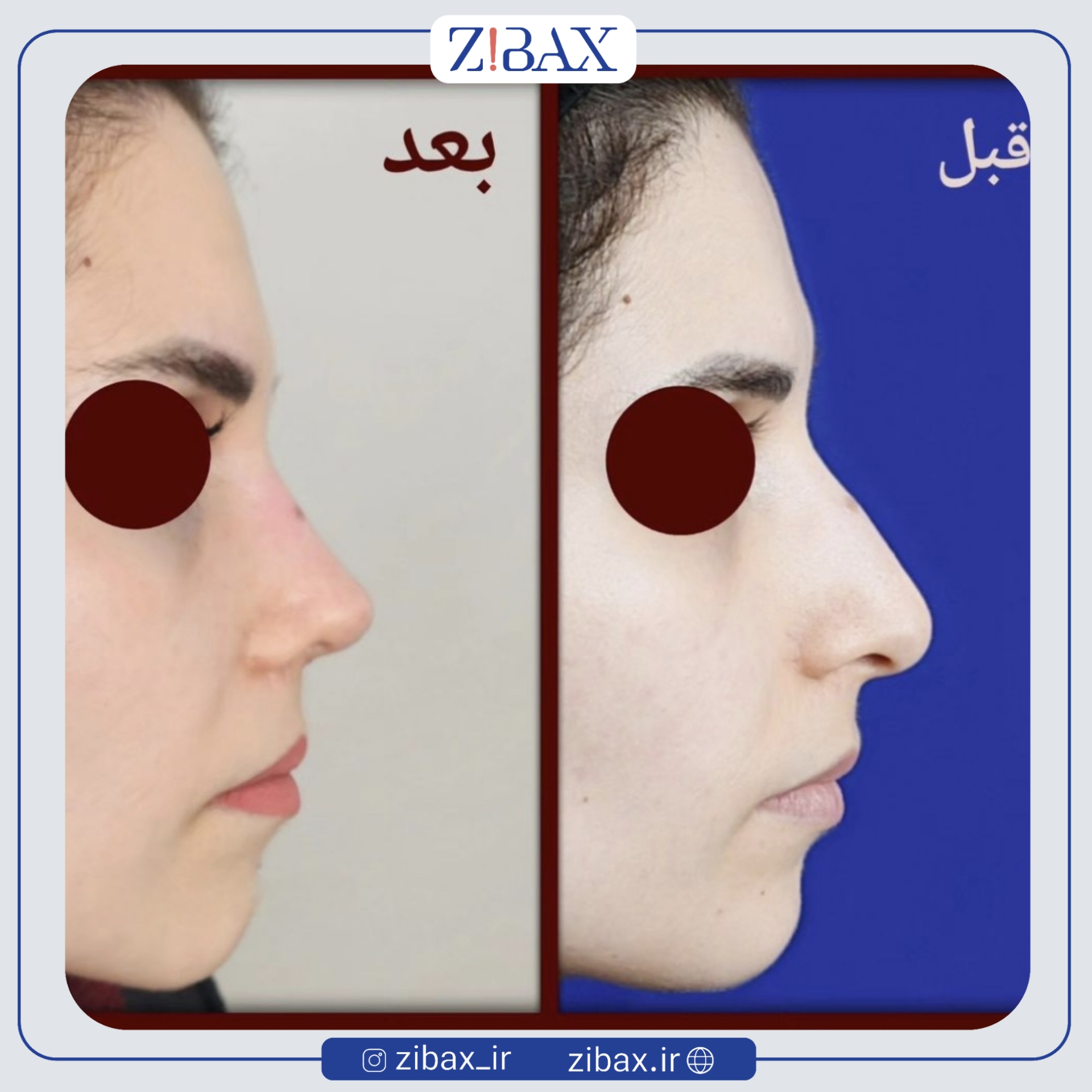 نتیجه جراحی