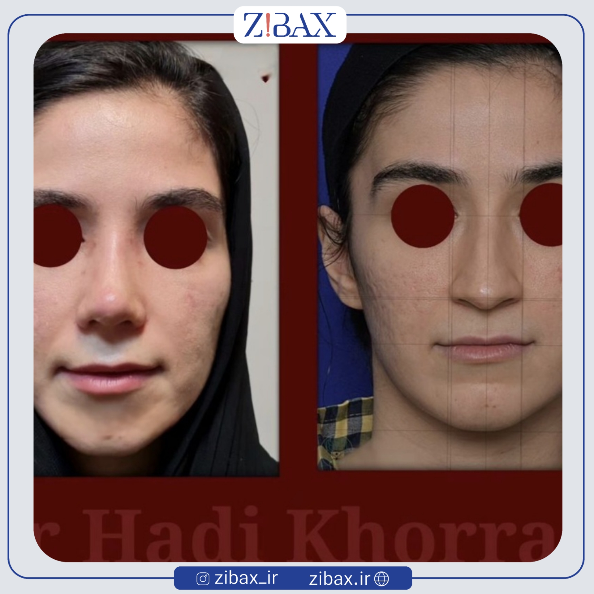 نتیجه جراحی