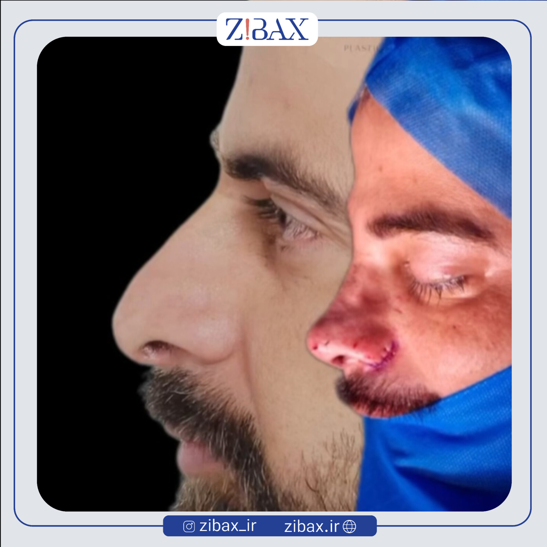 نتیجه جراحی