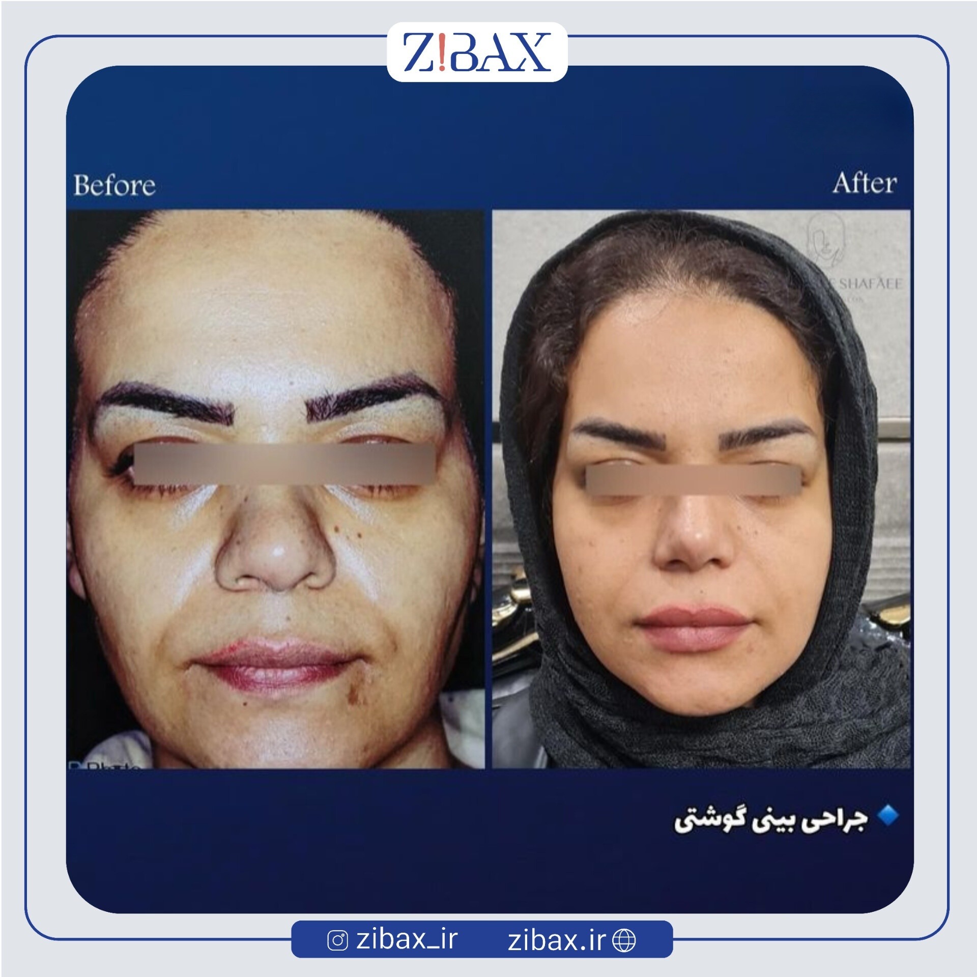 نتیجه جراحی
