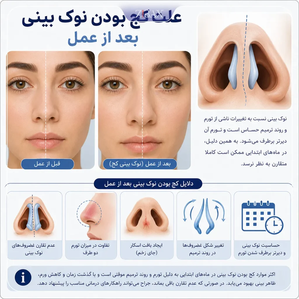 علت کج شدن نوک بینی بعد از عمل