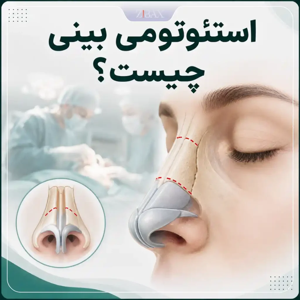 استئوتومی بینی چیست؟