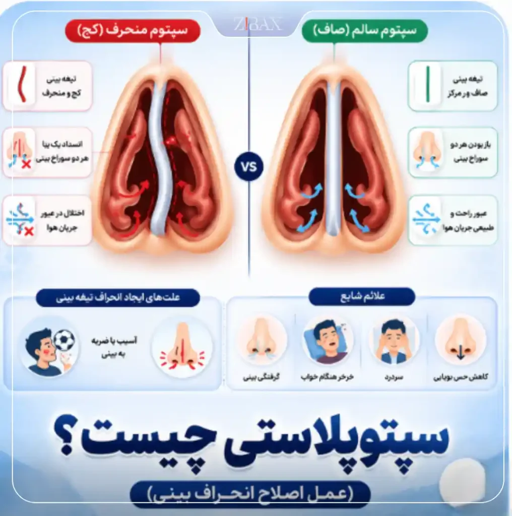 جراحی سپتوپلاستی چیست