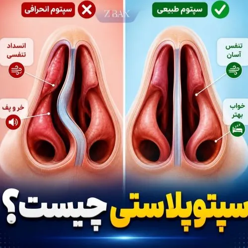 سپتوپلاستی چیست؟
