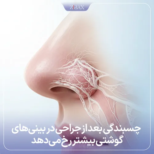 چسبندگی بینی بعد از رینوپلاستی در بینی‌های گوشتی و استخوانی