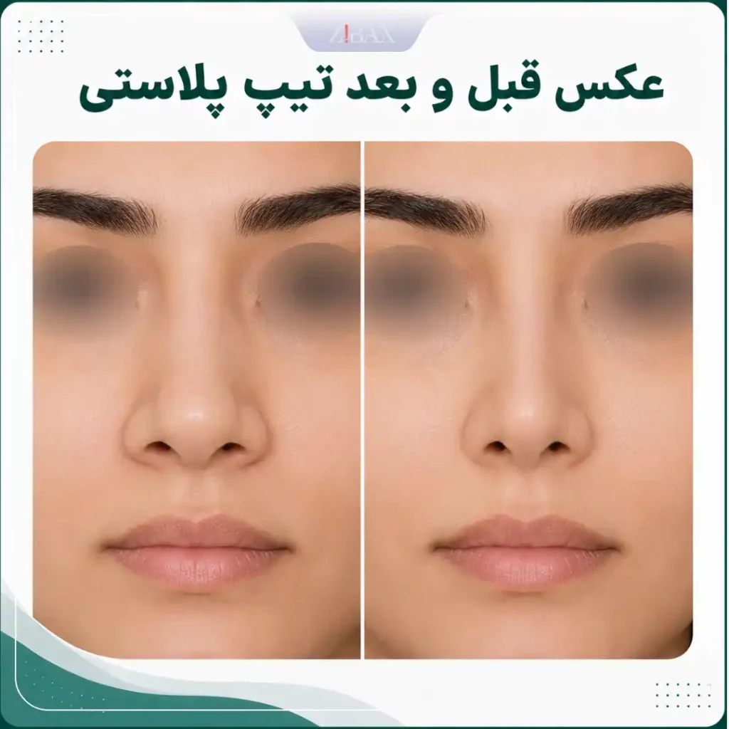 عکس قبل و بعد تیپ پلاستی