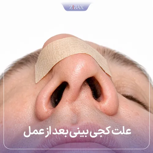 بررسی علت‌های کجی بینی بعد از عمل بینی