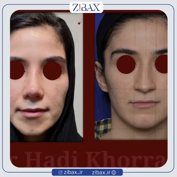 نمونه عمل جراحی بینی دکتر هادی خرم — تصویر 8