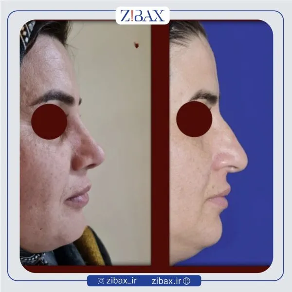 نمونه عمل جراحی بینی دکتر هادی خرم — تصویر 10