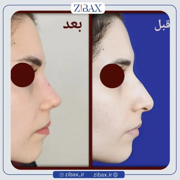 نمونه عمل جراحی بینی دکتر هادی خرم — تصویر 5