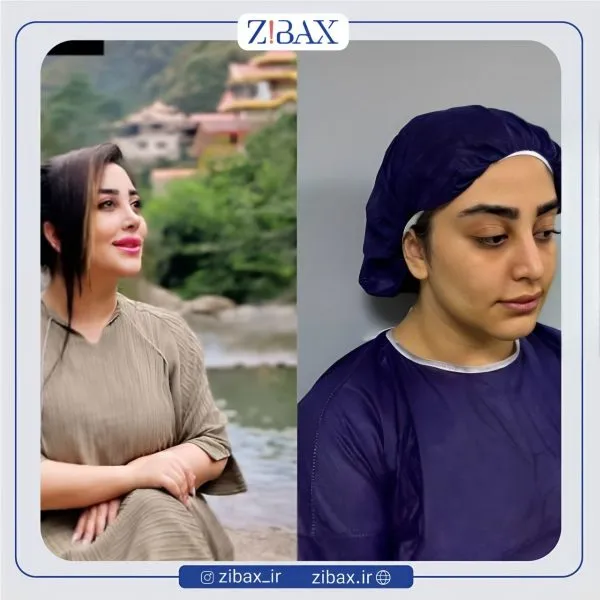 نمونه عمل جراحی بینی دکتر کامبیز پوریوسف — تصویر 11