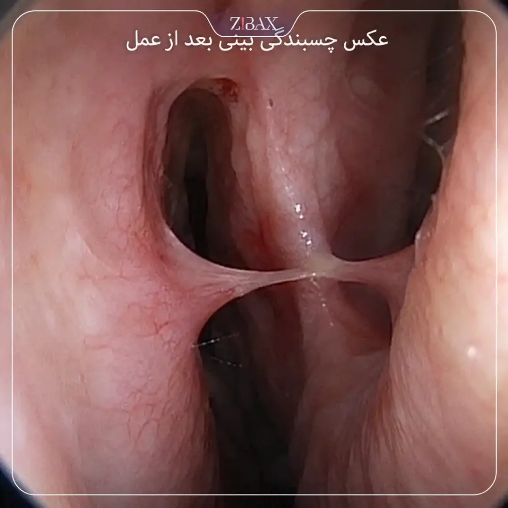 عکس چسبندگی بینی بعد از عمل