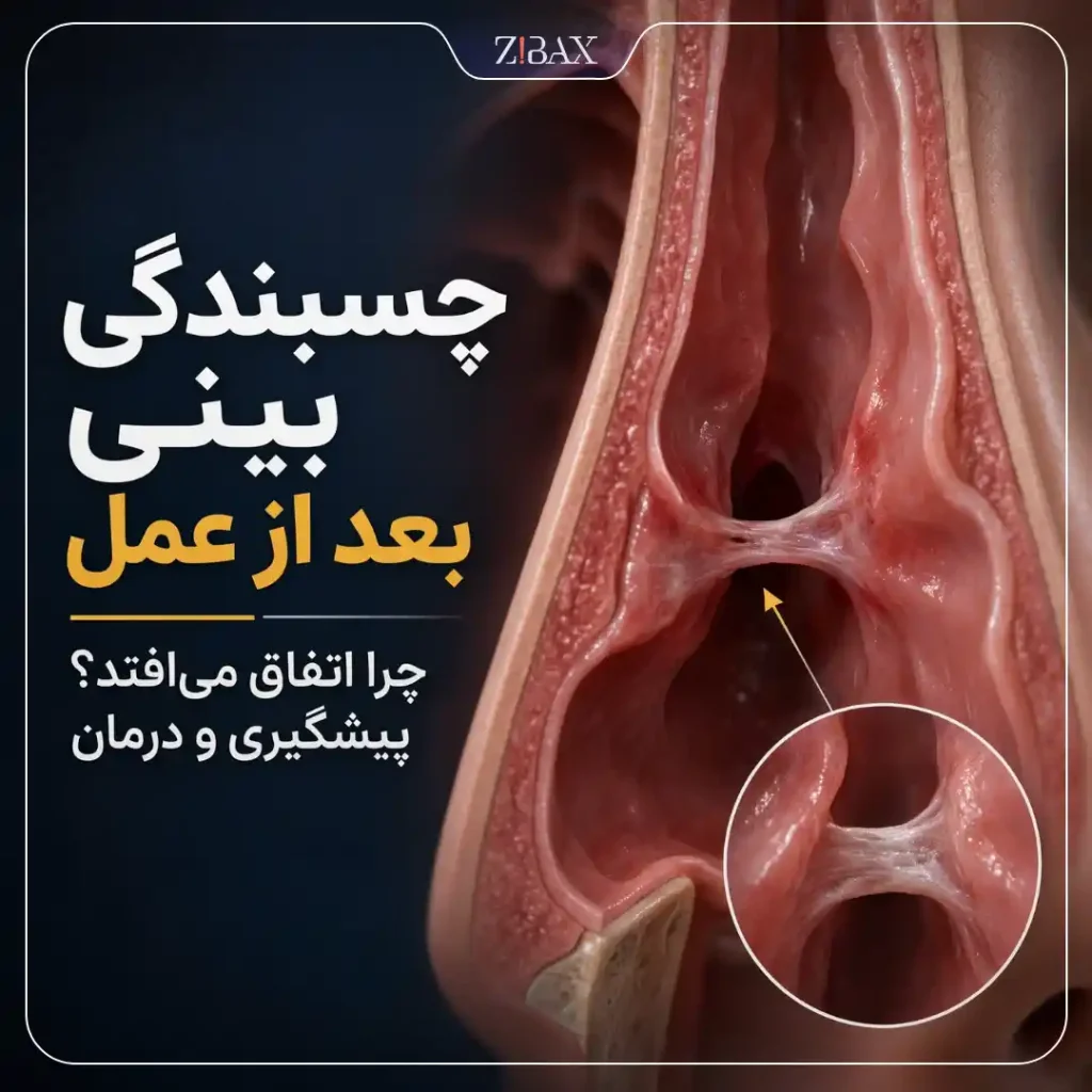 چسبندگی بینی بعد از عمل