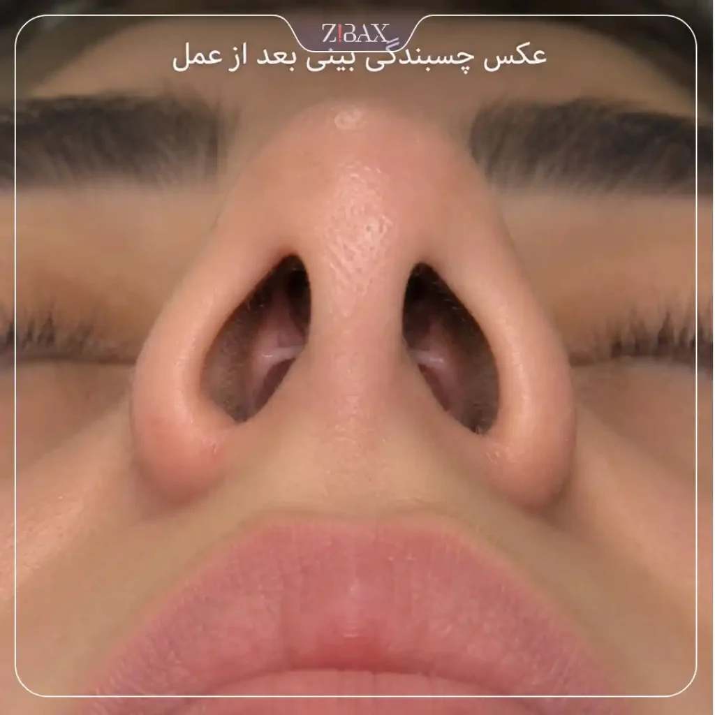 عکس چسبندگی بینی بعد عمل