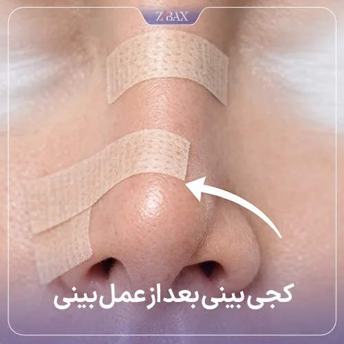 کج شدن بینی بعد از عمل بینی