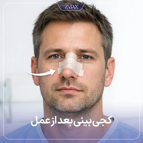 کجی بینی بعد از عمل