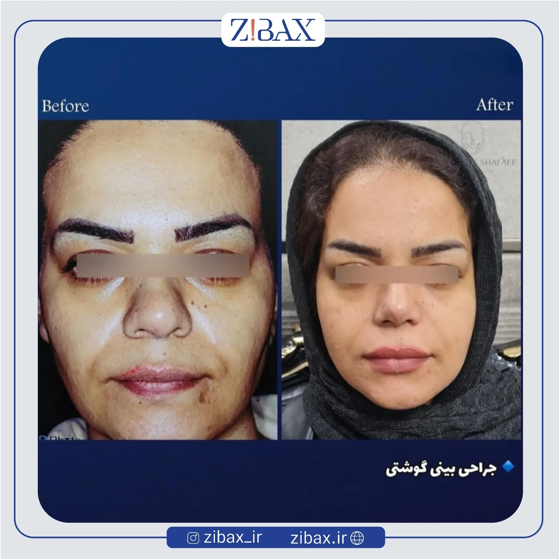 نمونه عمل جراحی بینی دکتر یوسف شفایی خانقاه — تصویر 8
