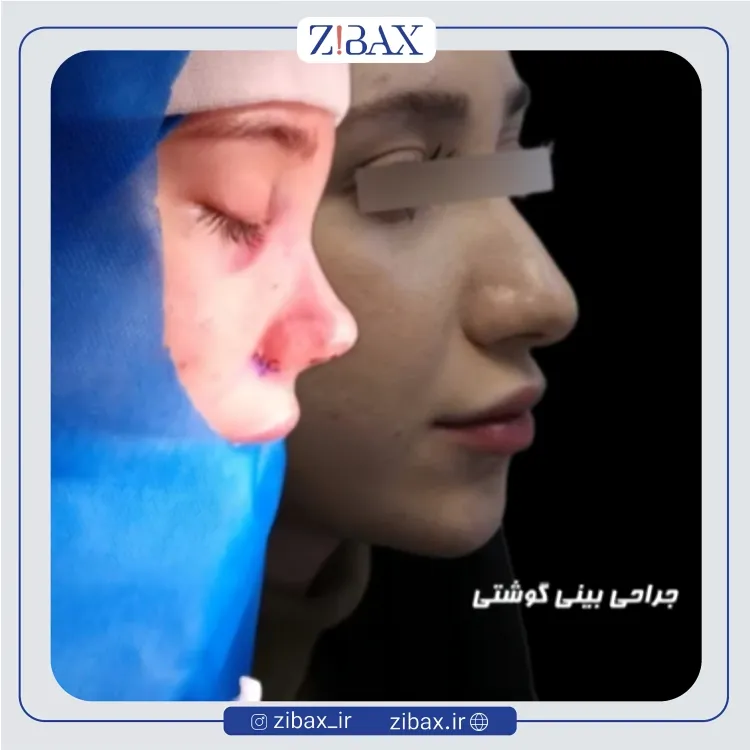 نمونه عمل جراحی بینی دکتر یوسف شفایی خانقاه — تصویر 9