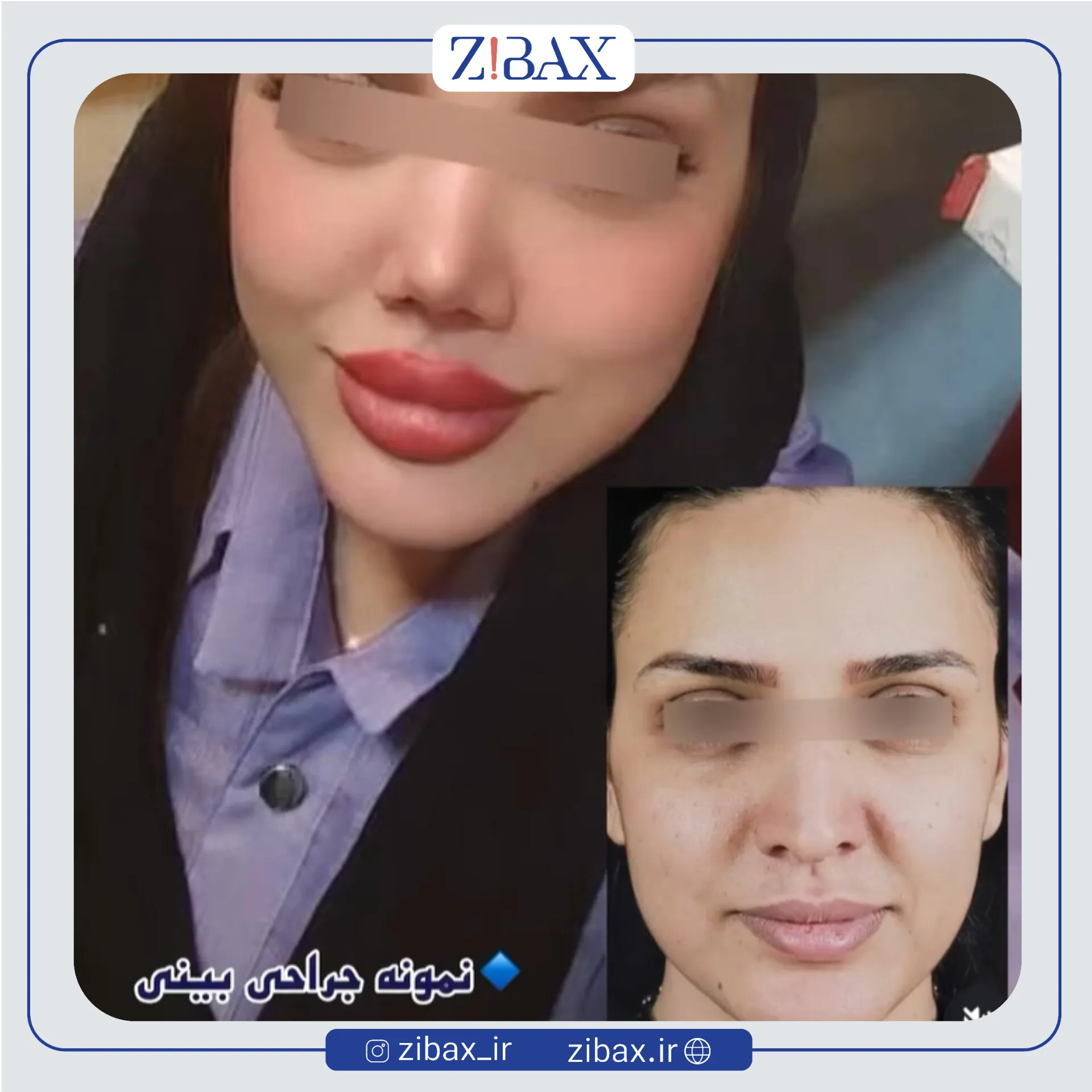 نمونه عمل جراحی بینی دکتر یوسف شفایی خانقاه — تصویر 1