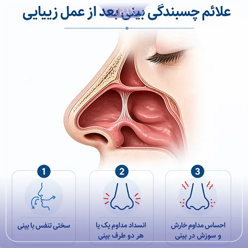نشانه‌های چسبندگی بینی بعد از عمل بینی