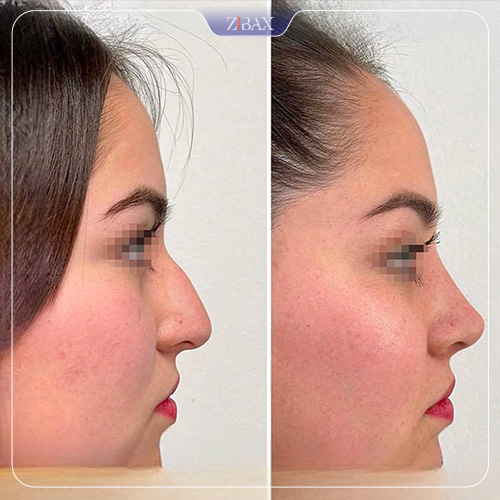 نمونه عمل جراحی بینی دکتر اکبر اعتمادی — تصویر 6