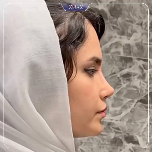 نمونه عمل جراحی بینی دکتر اکبر اعتمادی — تصویر 7