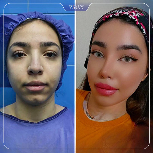 نمونه عمل جراحی بینی دکتر اکبر اعتمادی — تصویر 9