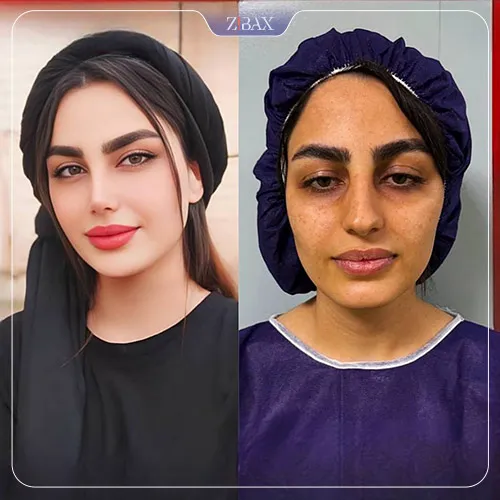 نمونه عمل جراحی بینی دکتر خسرو مقتدر — تصویر 6