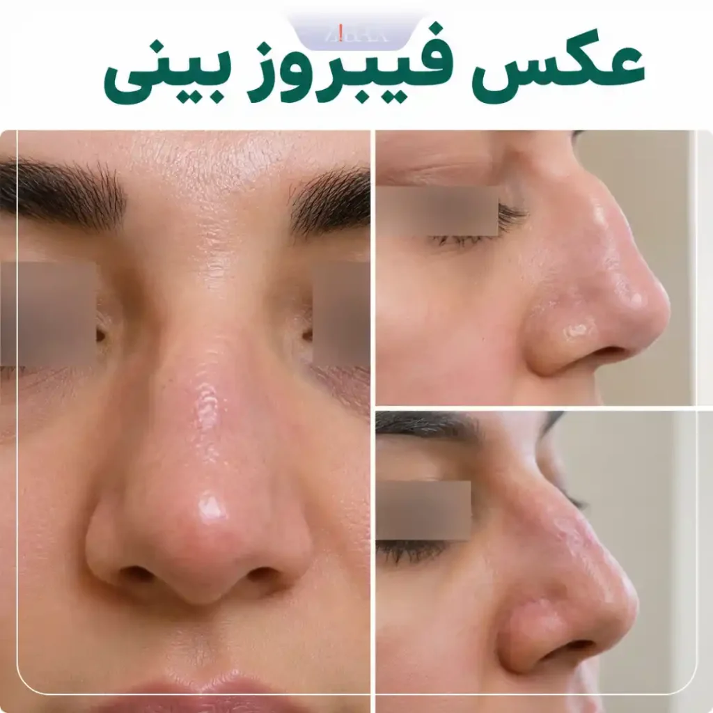 عکس فیبروز بینی