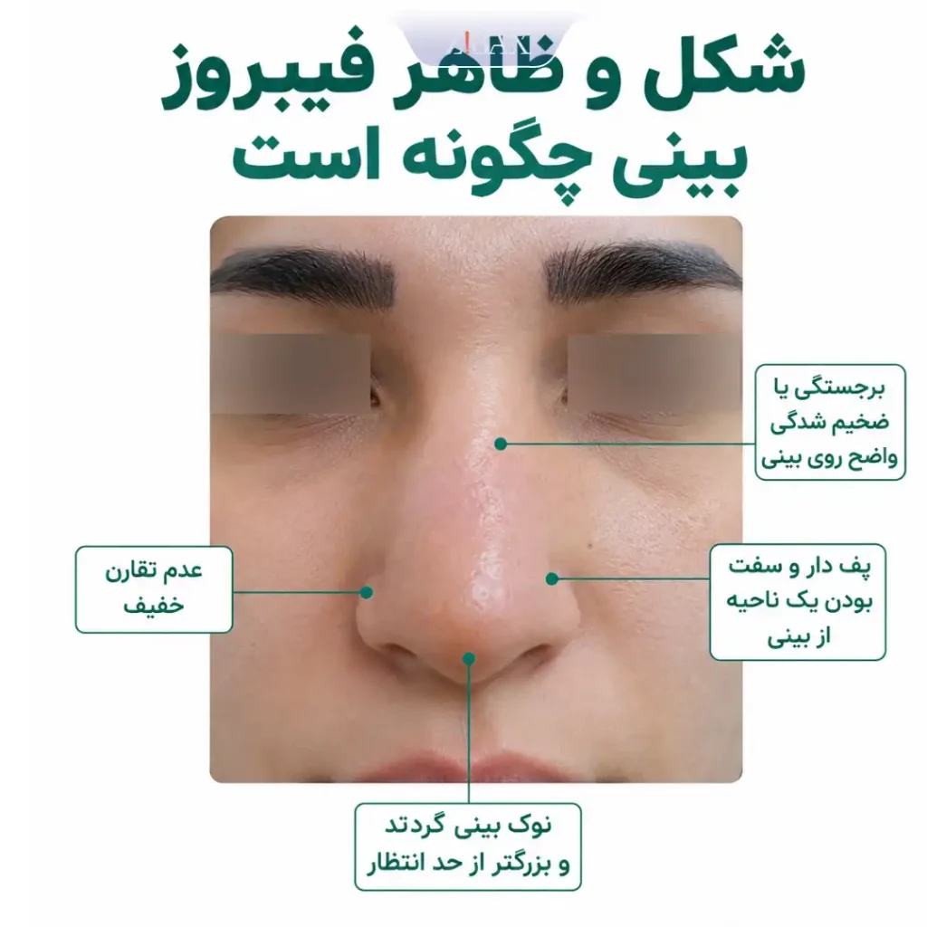 عکس فیبروز بینی بعد از عمل