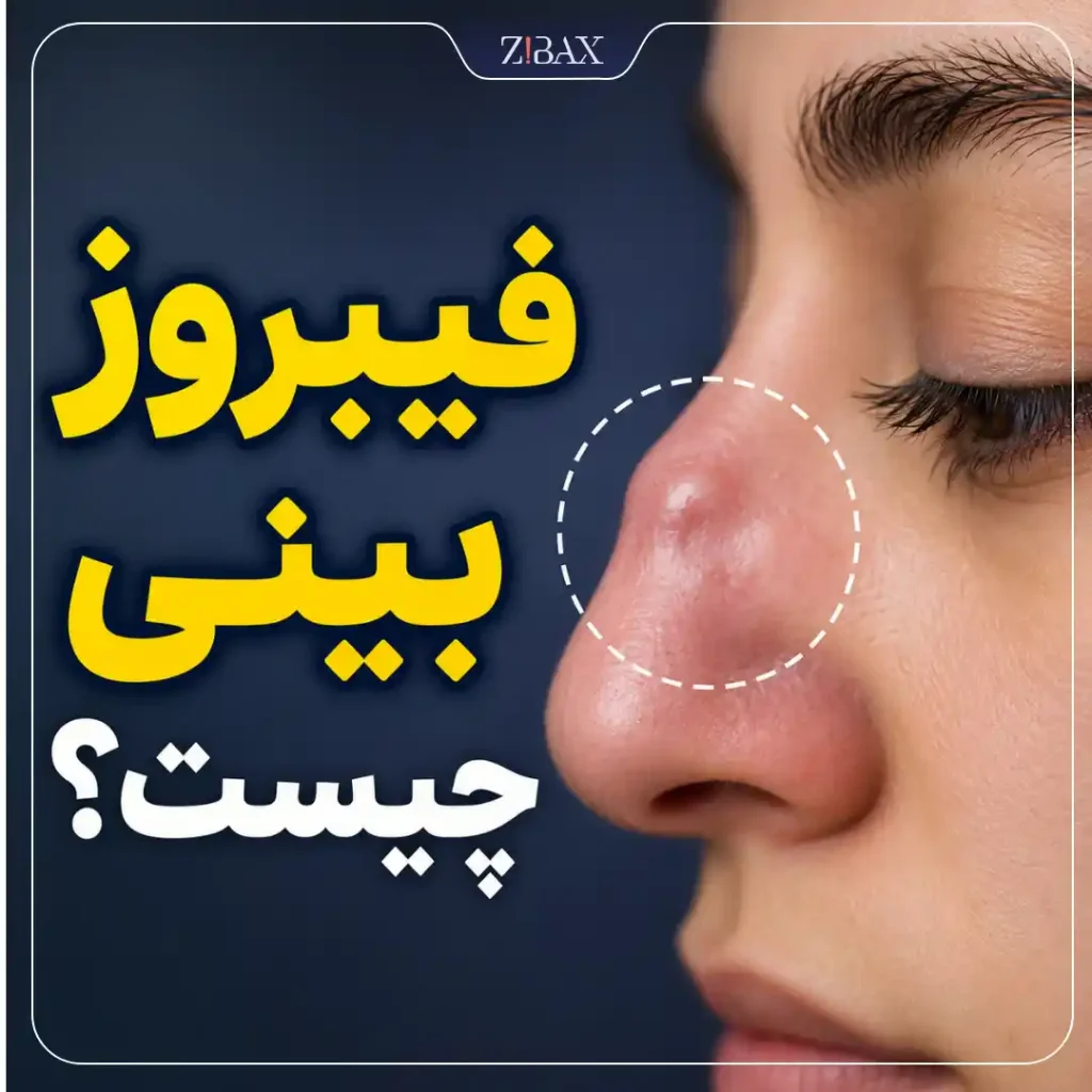 فیبروز بینی چیست