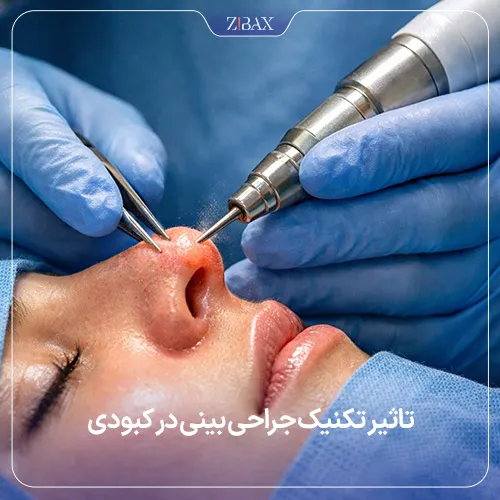 تاثیر تکنیک جراحی بر کبودی عمل بینی