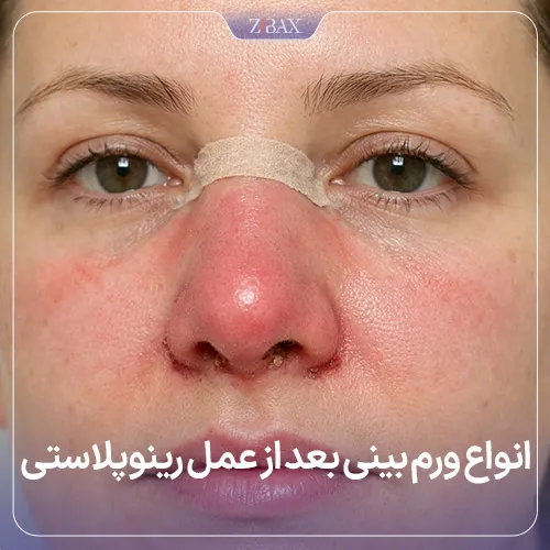 بررسی انواع ورم بینی بعد از عمل