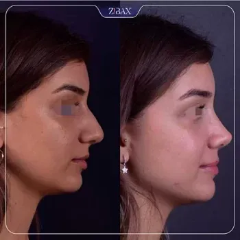 نمونه عمل جراحی بینی دکتر حمزه هاشمی — تصویر 6