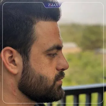نمونه عمل جراحی بینی دکتر حمزه هاشمی — تصویر 8