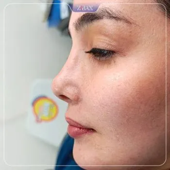 نمونه عمل جراحی بینی دکتر حمزه هاشمی — تصویر 9