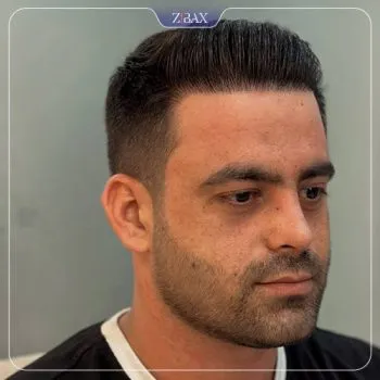 نمونه عمل جراحی بینی دکتر حمزه هاشمی — تصویر 4